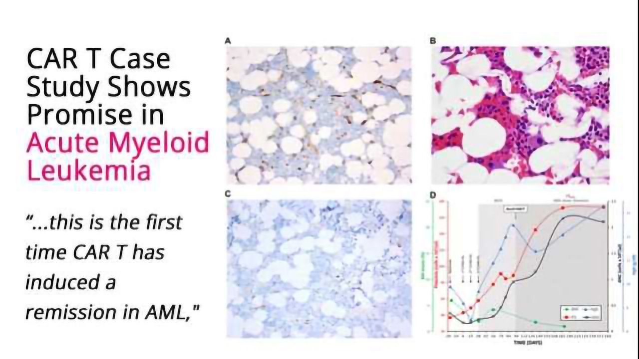 CAR T Cell Therapy Shows Promise in Acute Myeloid Leukemia