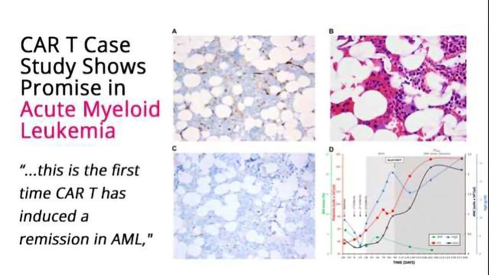 CAR T Cell Therapy Shows Promise in Acute Myeloid Leukemia | Technology ...