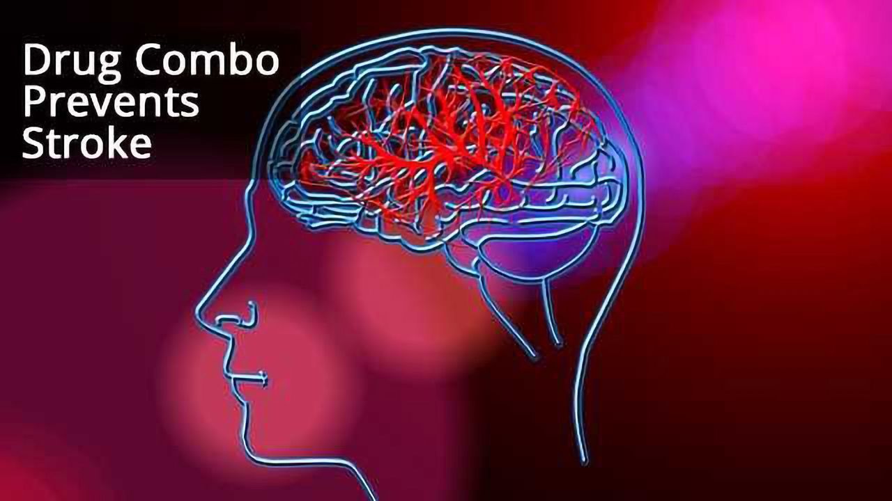 Drug Combo Prevents Stroke, Shows Promise for Clinic