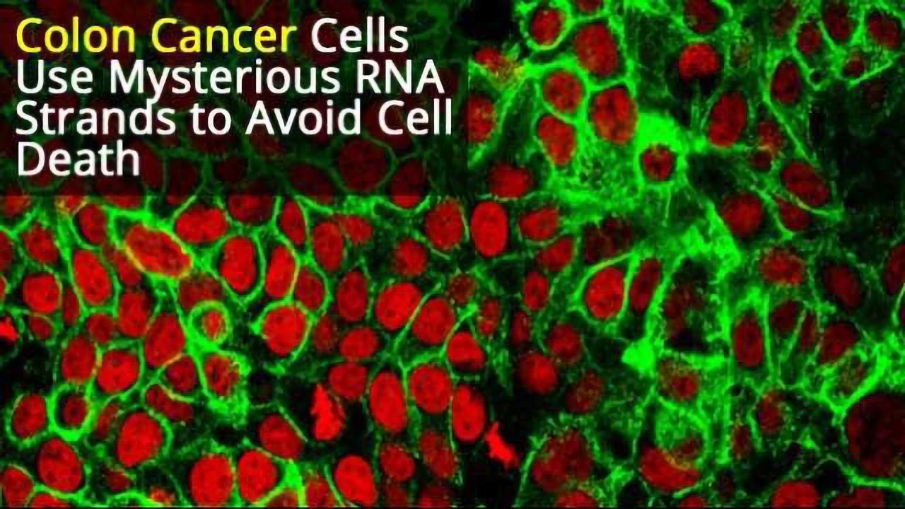 Colon Cancer Cells Use RNA Strands to Evade Cell Death