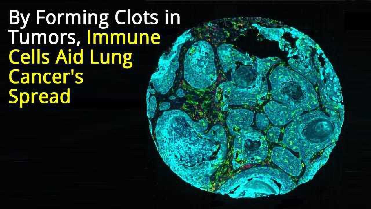 Immune Cells Form Clots in Tumors Aiding Lung Cancer's Spread