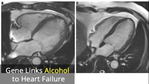 Faulty Gene Leads to Alcohol-Induced Heart Failure