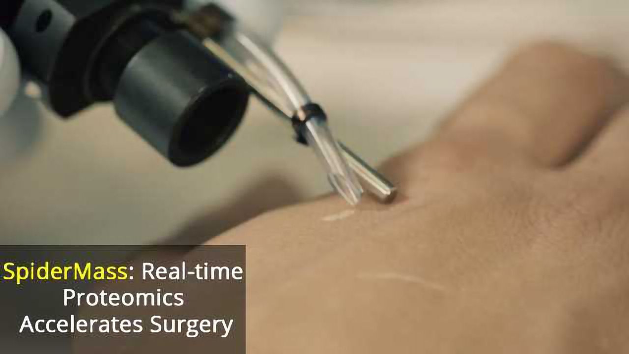 SpiderMass Device to Speed Up Cancer Surgery