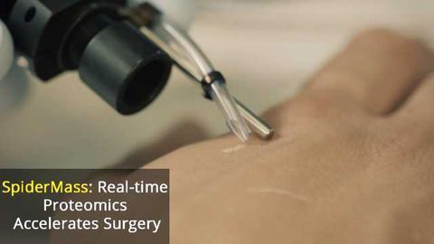 SpiderMass Device to Speed Up Cancer Surgery