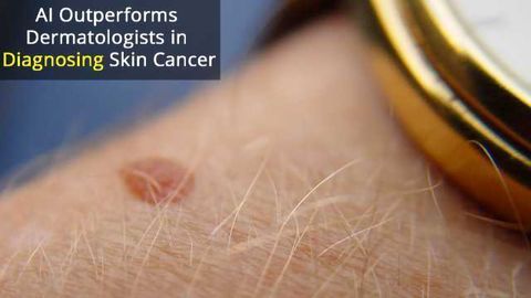 Computer Beats Experts in Diagnosing Skin Cancer