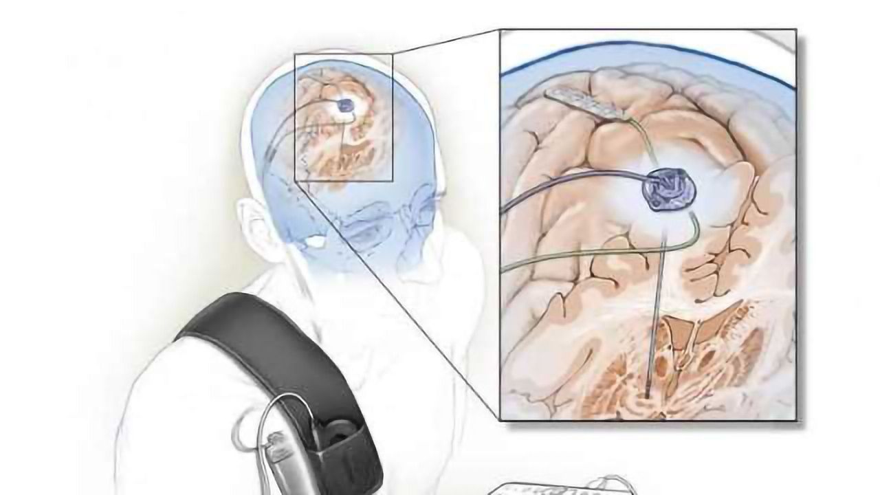 Self-tuning Brain Implant Could Help Treat Patients with Parkinson’s Disease