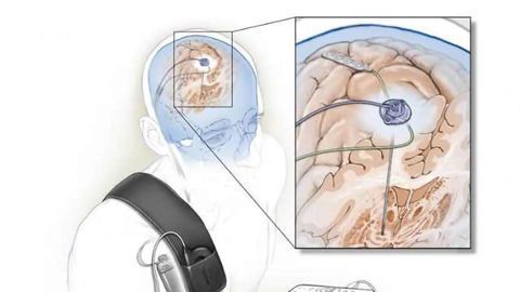 Self-tuning Brain Implant Could Help Treat Patients with Parkinson’s Disease