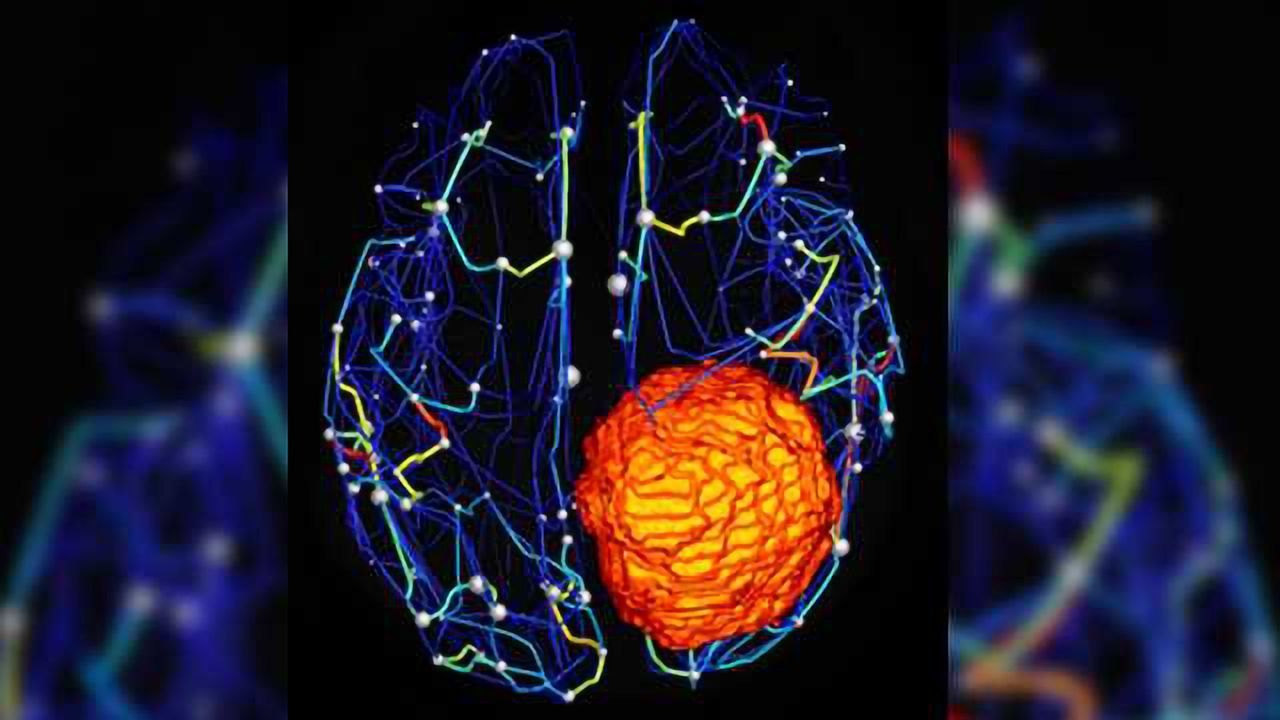 Virtual Brain Models Brain Tumor Progression, Effects of Surgery