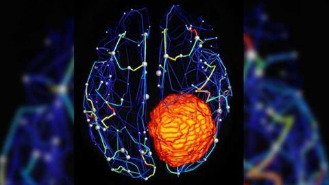 Virtual Brain Models Brain Tumor Progression, Effects of Surgery
