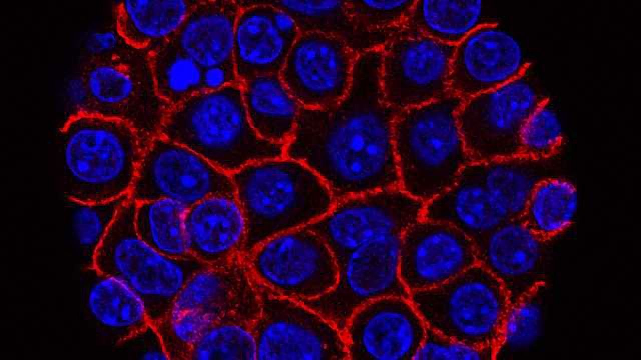 Organoid Profiling Personalizes Treatments For Pancreatic Cancer