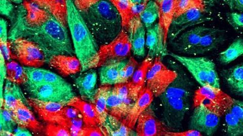 Immunotherapy Beneficial in Some Men with Prostate Cancer