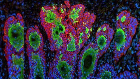 Antibody Shrinks Tumors of Patients with Advanced Skin Cancer