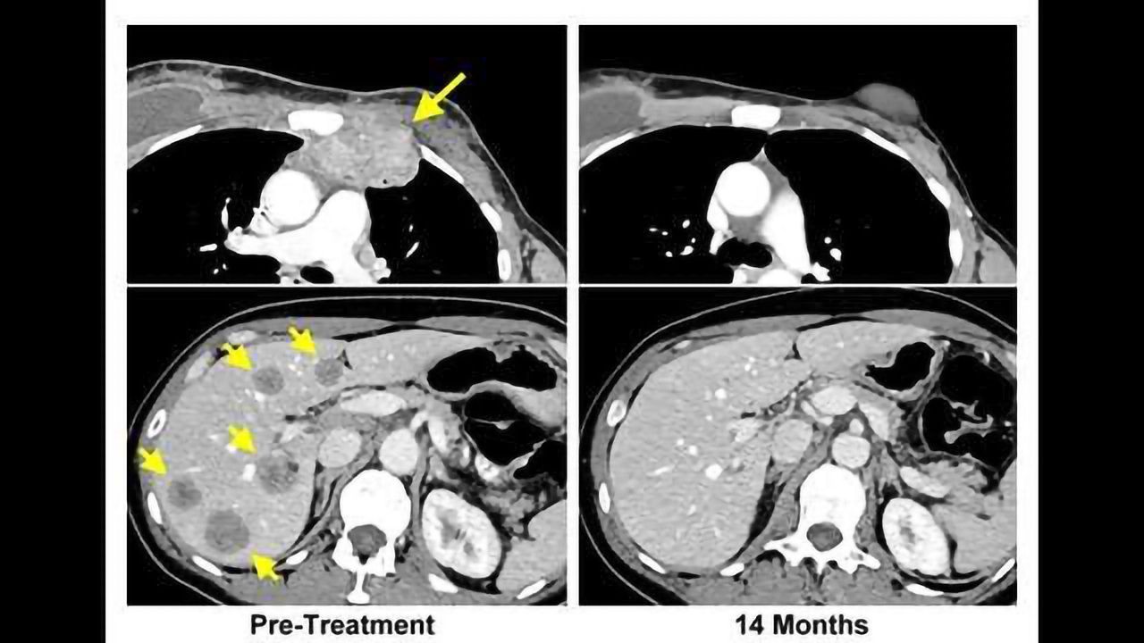 Immunotherapy Approach Leads to Complete Response in Breast Cancer Patient