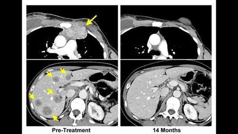 Immunotherapy Approach Leads to Complete Response in Breast Cancer Patient
