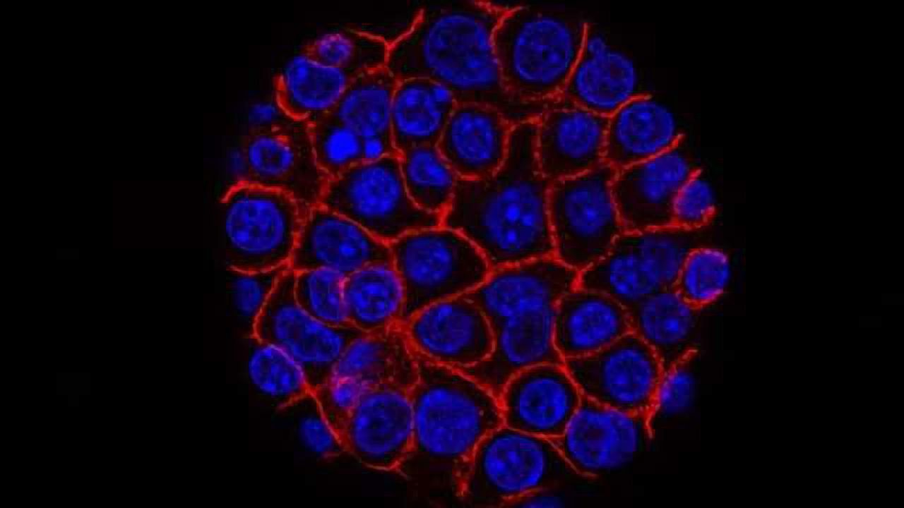 Chemoradiotherapy Before Surgery Could Extend Lives of Pancreatic Cancer Patients