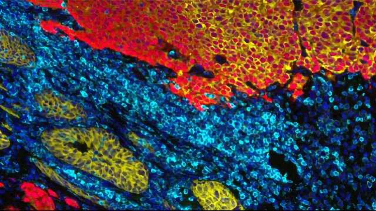 63 New Genetic Variations in DNA Increase Prostate Cancer Risk