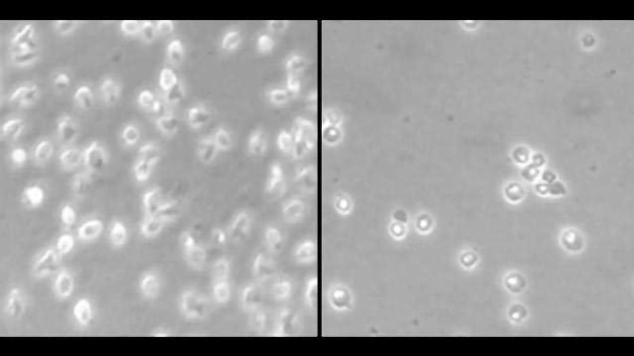 Epigenetic Drug Against Mantle Cell Lymphoma