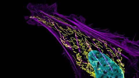 Genetic Discovery Helps Determine the Difference Between Aggressive & Benign Bone Tumors