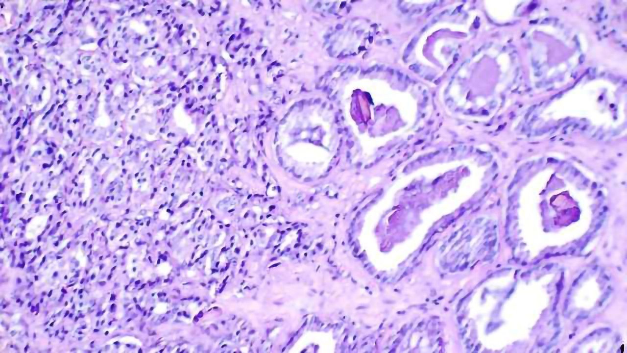 Digital Pathology Solution Could Speed Up Prostate Cancer Diagnosis