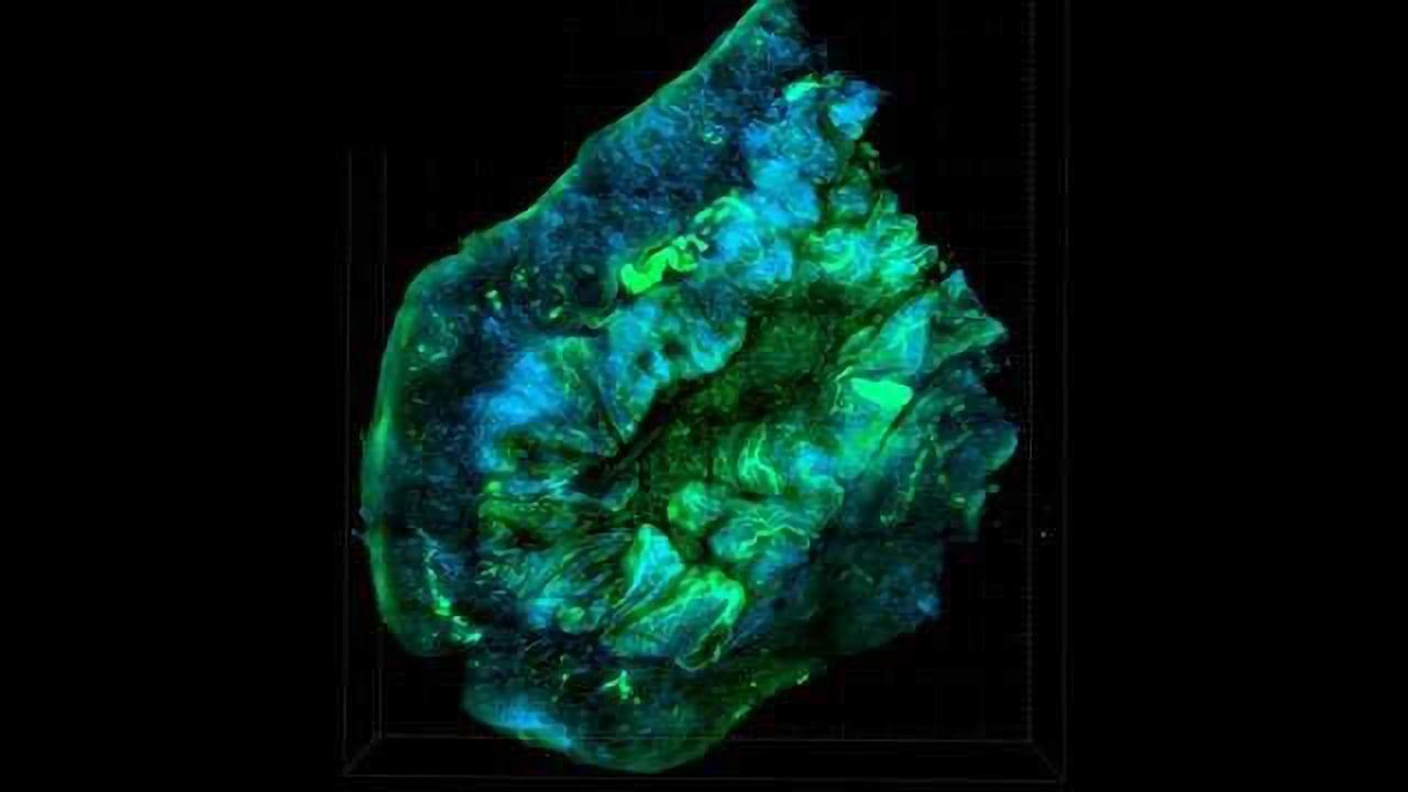 New Ovarian Cancer Target