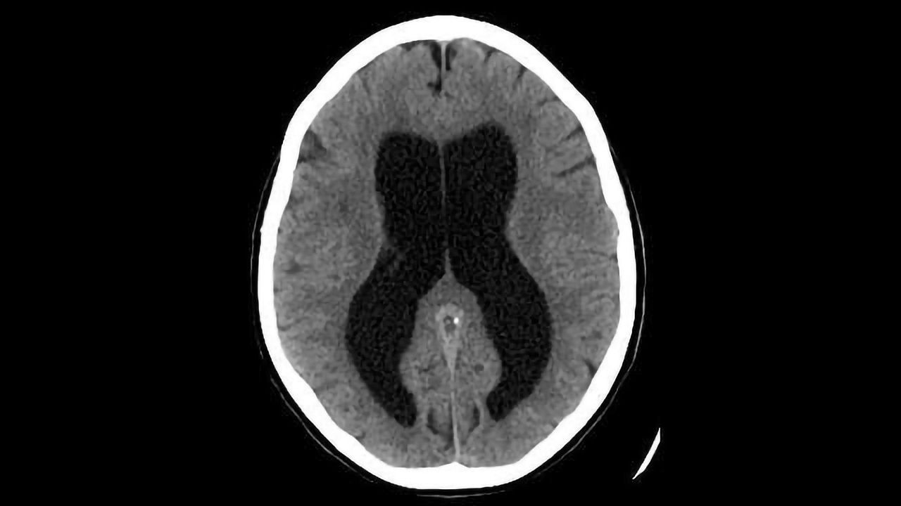 Understanding Brain’s Water System May Prove Beneficial in Stroke
