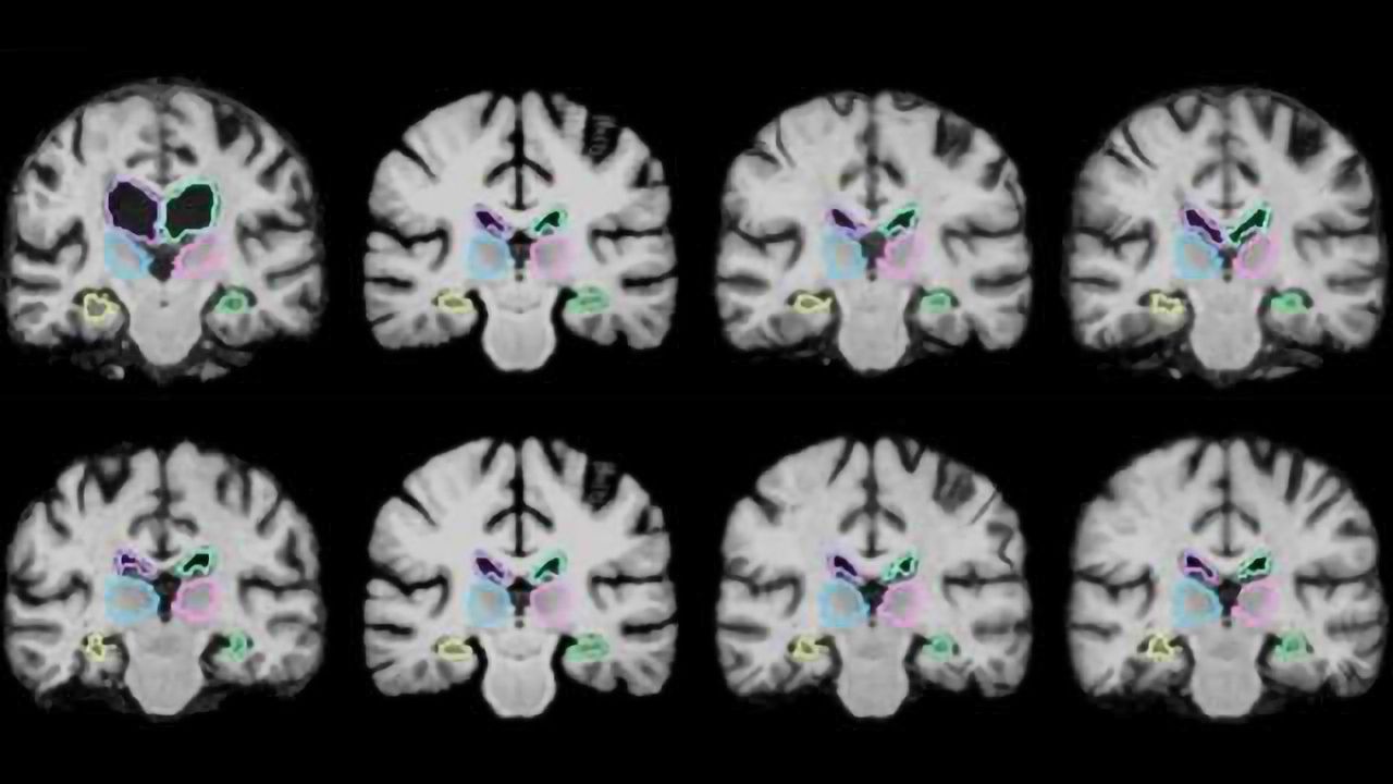 Algorithm Enables Real-time Brain Scan Registering