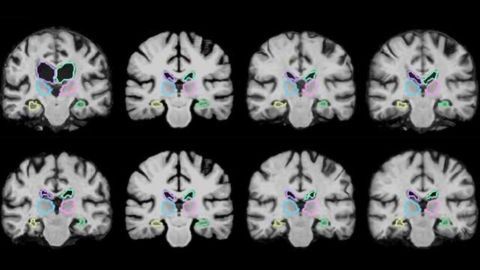 Algorithm Enables Real-time Brain Scan Registering
