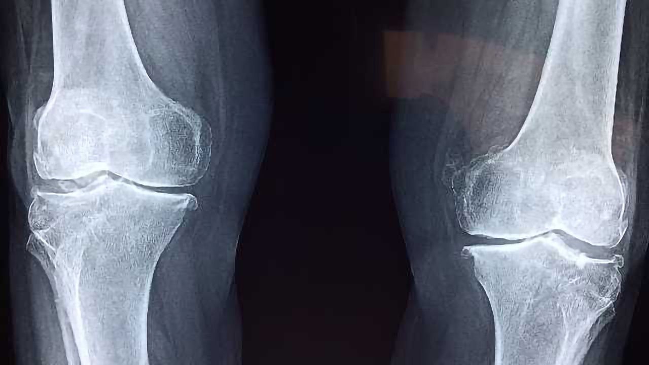 Cell Technology Used to Treat Osteochondral Knee Defect