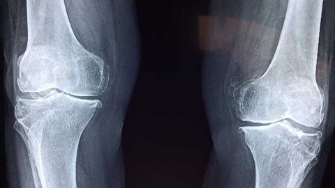 Cell Technology Used to Treat Osteochondral Knee Defect