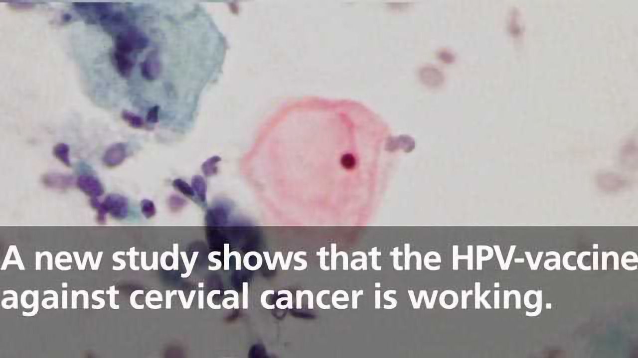 Study Shows HPV-vaccine Against Cervical Cancer is Working
