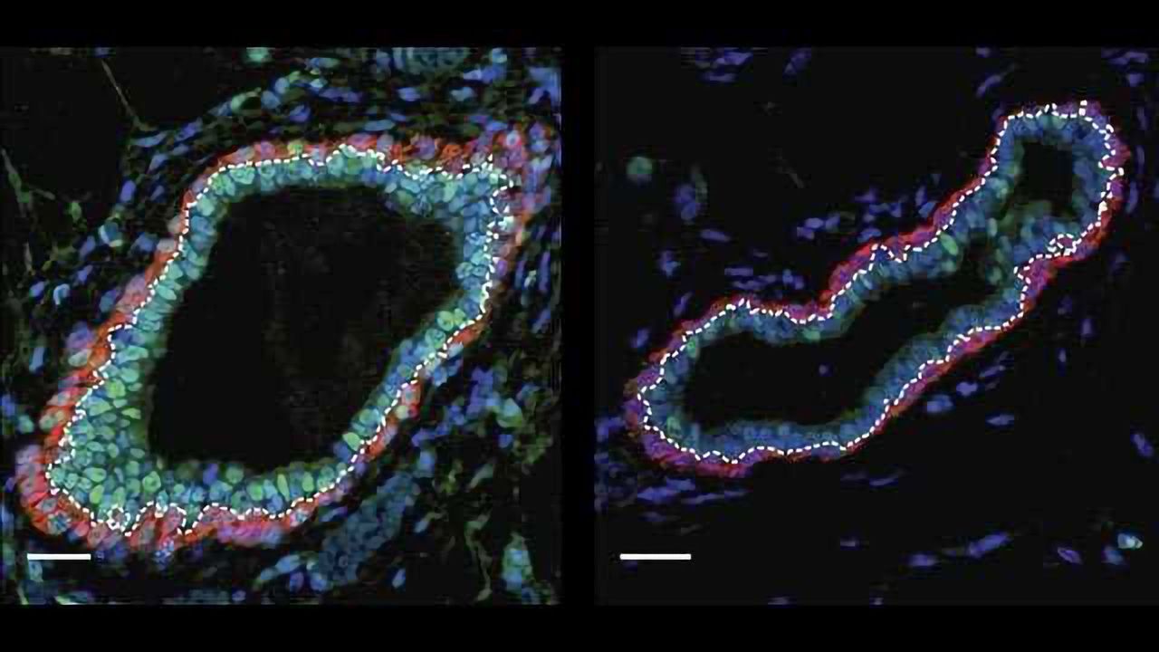 Targeting Epigenetic Proteins to Prevent Breast Cancer