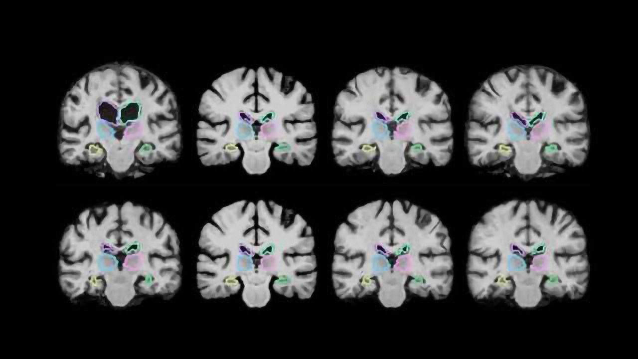 Algorithm Speeds Up Medical Image Analysis 1000 Times