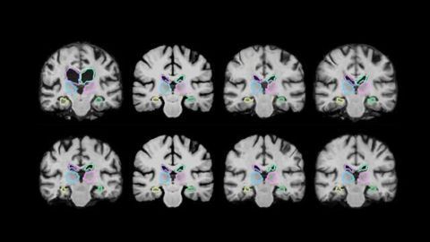 Algorithm Speeds Up Medical Image Analysis 1000 Times