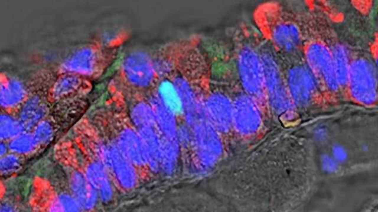New Type of Lung Cancer Discovered