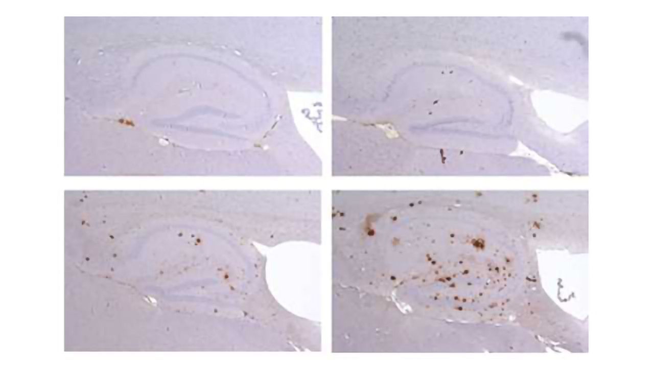 Genes Linking Alzheimer’s and Down Syndrome Discovered