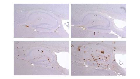 Genes Linking Alzheimer’s and Down Syndrome Discovered