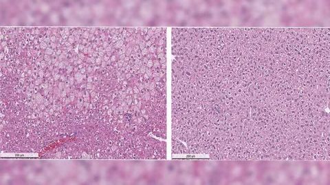 Promising Preclinical Results for Compound to Treat Wilson's Disease