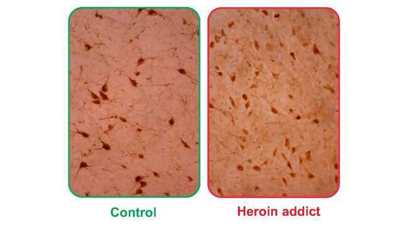 Wakefulness Molecule Orexin/Hypocretin Abundant in Brains of Heroin Addicts