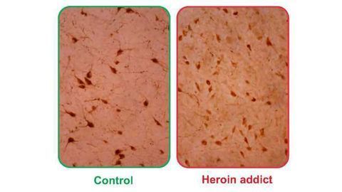 Wakefulness Molecule Orexin/Hypocretin Abundant in Brains of Heroin Addicts
