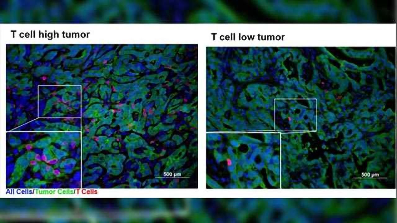 Revealing Secrets of 'Hot' & 'Cold' Pancreatic Cancer Tumors