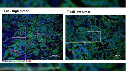 Revealing Secrets of 'Hot' & 'Cold' Pancreatic Cancer Tumors