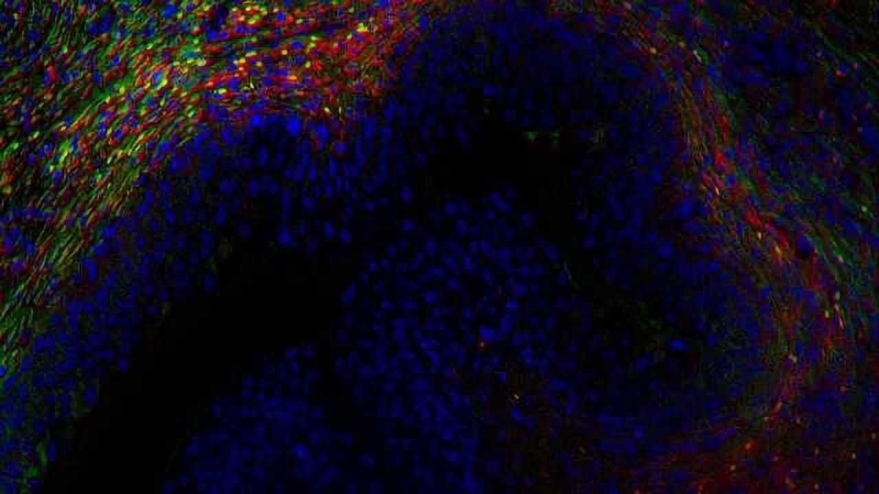 Simple Test Could Improve Bladder Cancer Treatment
