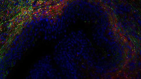 Simple Test Could Improve Bladder Cancer Treatment