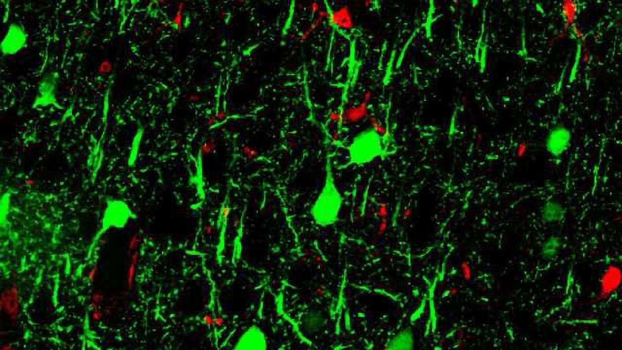MicroRNA Study Shows Promise in the Hunt for Alzheimer's Disease Test