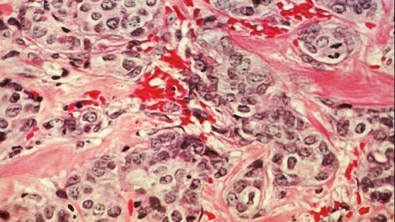 Advanced Breast Cancer: Triple Therapy Could Boost Treatment & Prevent Relapse
