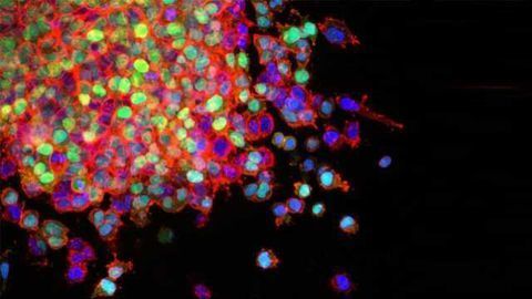Targeting Vulnerability in Deadly Form of Lung Cancer
