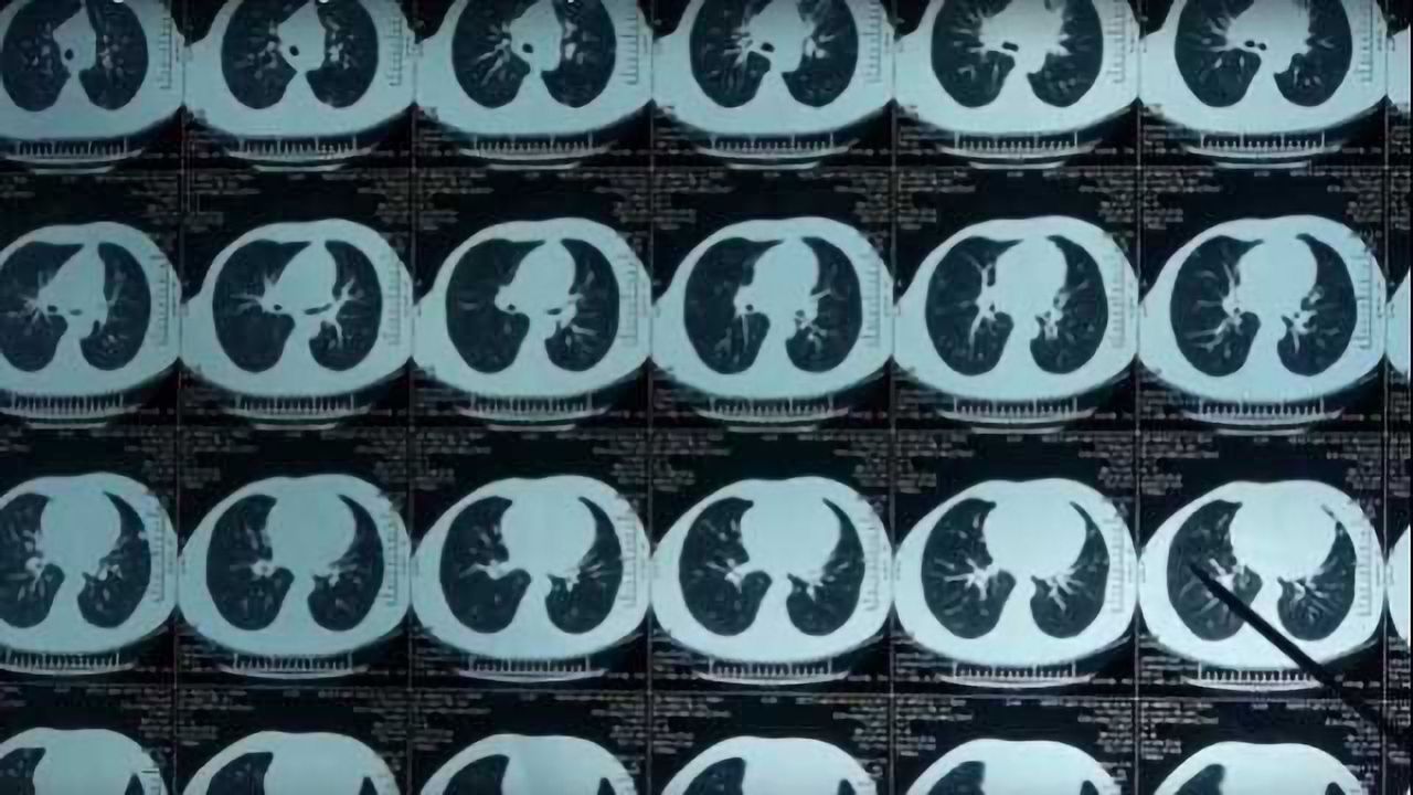 Researchers Discover New Vulnerability in Deadly Form of Lung Cancer