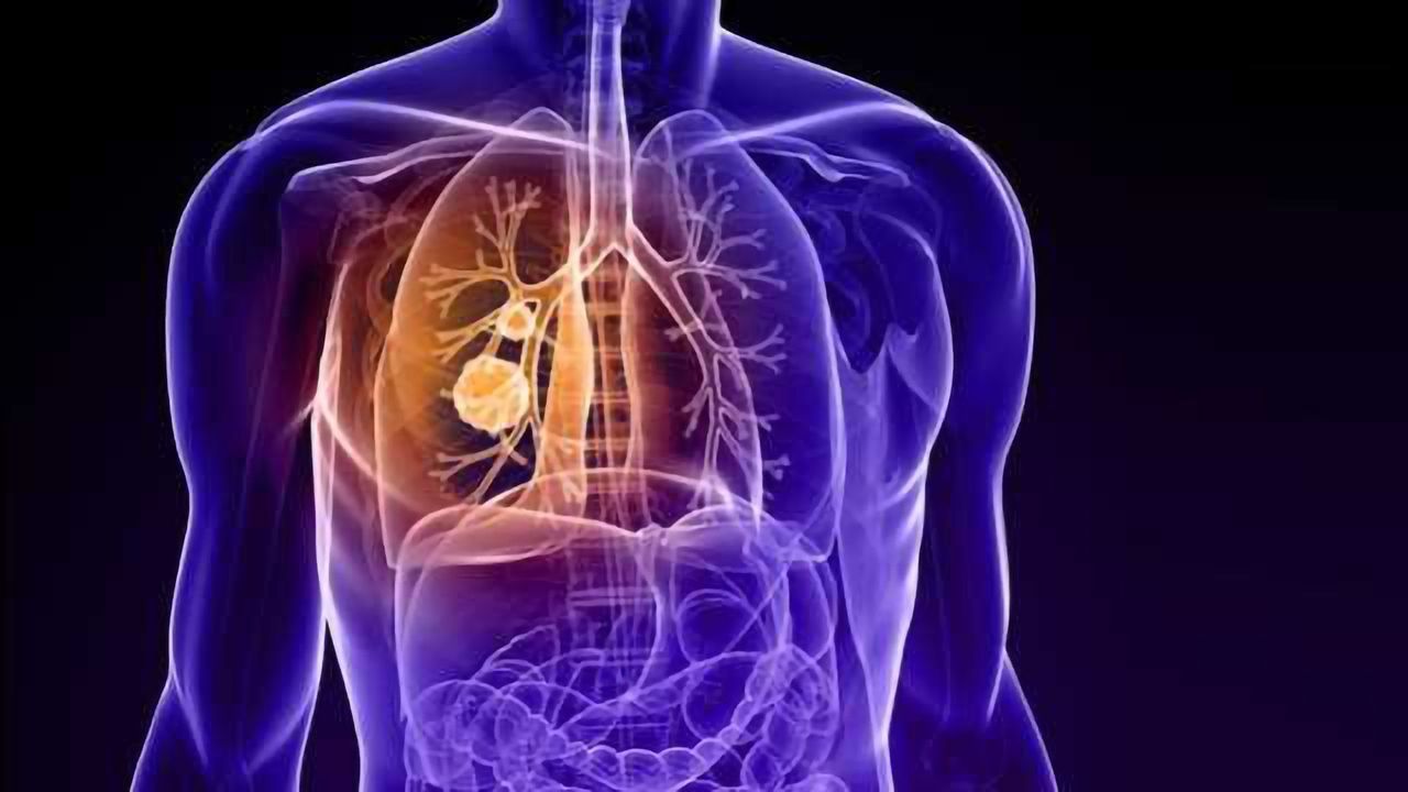 Determining Prognostic Significance of Biomarkers for Risk Stratification of Early Stage Lung Cancer