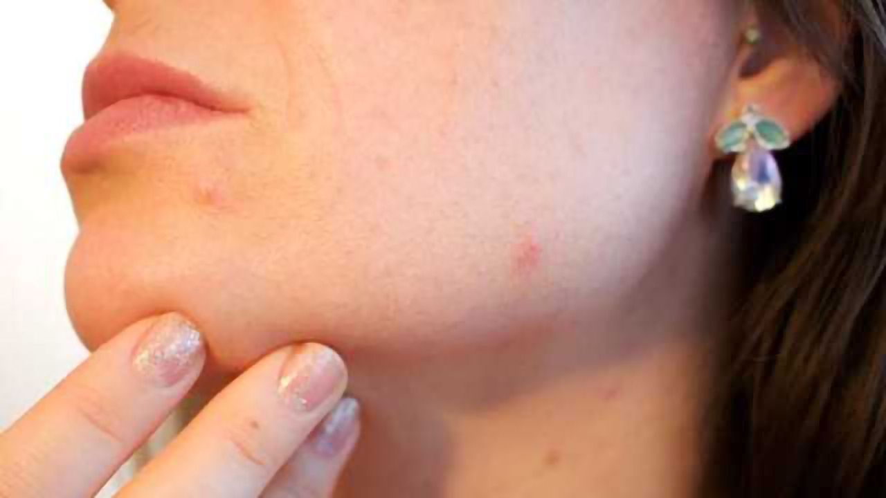 Investigational Acne Treatment Shows Promise in Laboratory Studies