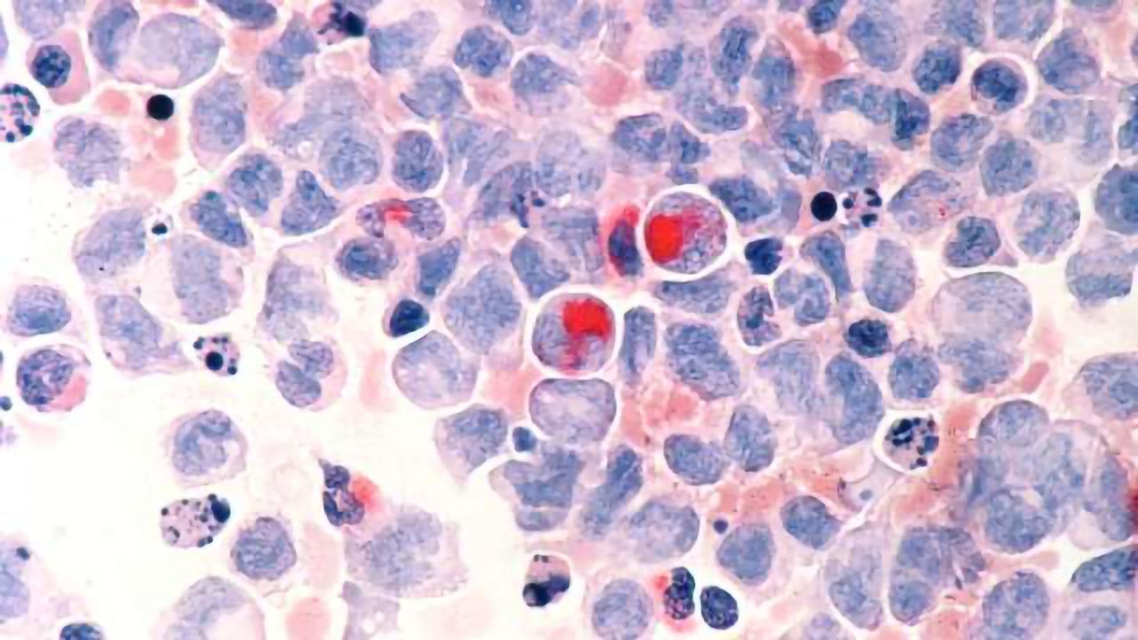 Roots of Leukaemia Reveal Possibility of Predicting People at Risk